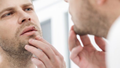 Photo of a man looking at his cold sore in the mirror