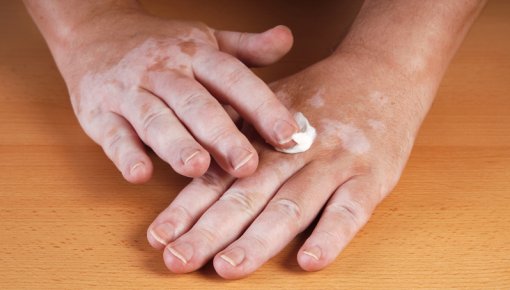Photo of topical medication being applied to the hand