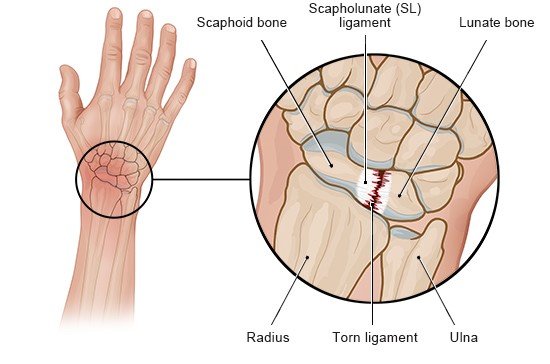 Illustration: Torn ligament in the wrist