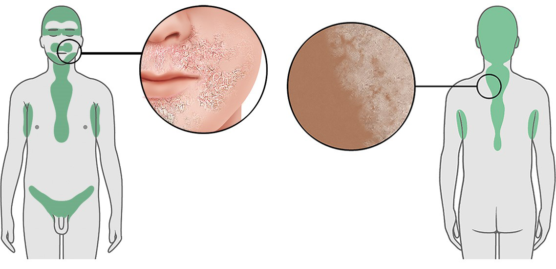 Illustration: Seborrheic dermatitis: Typical areas and appearance on light and dark skin 