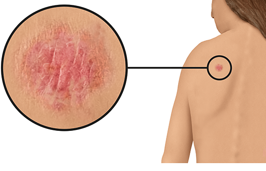 Illustration: Non-melanoma skin cancer might look like this on the shoulder (light skin)