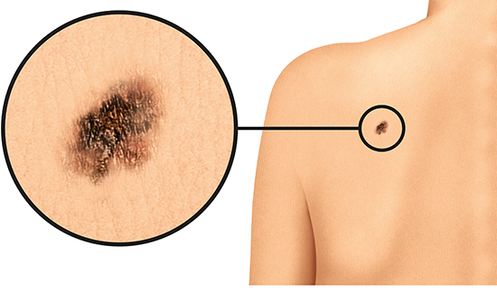 Illustration: Melanoma skin cancer on the shoulder (light skin)
