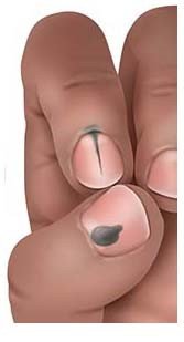 Illustration: Melanoma skin cancer on a finger (dark skin)
