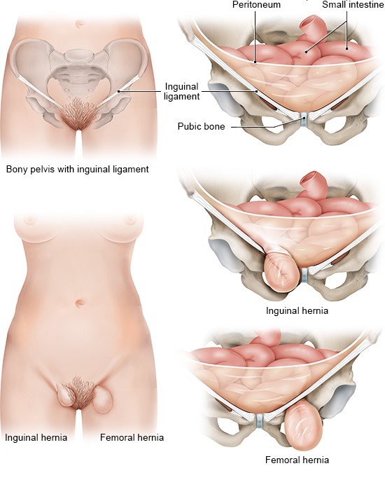 Illustration: Inguinal and femoral hernia in women