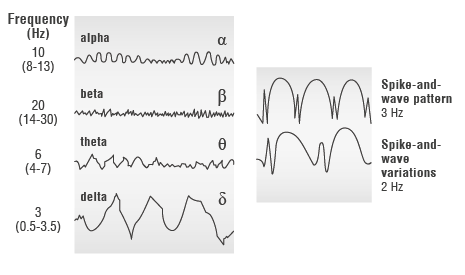 Illustration: Normal EEG waves (left) and the spike-and-wave pattern in epilepsy (right)