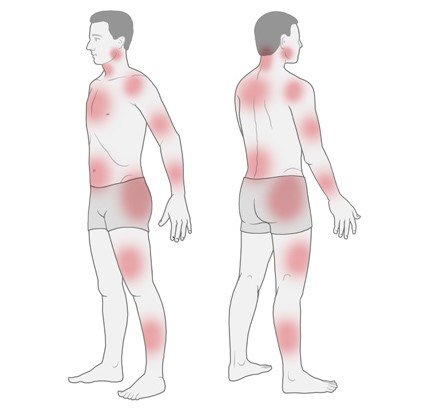 Illustration: Possible painful areas in fibromyalgia – as described in the article