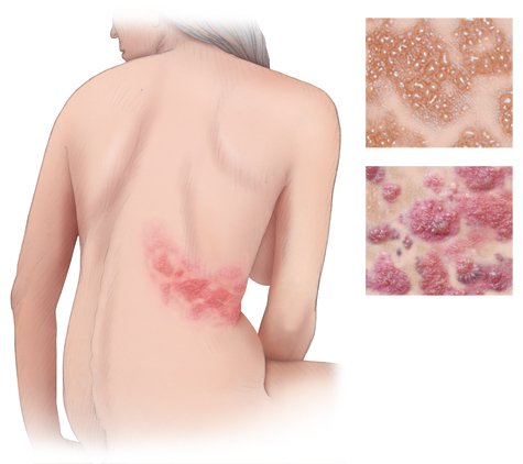 Illustration: Shingles: Typical rash on one side of the body only