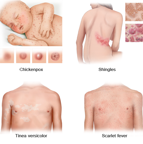 Typical skin changes due to common infectious diseases 