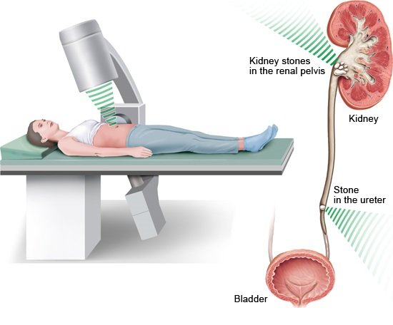 Illustration: During shock wave therapy – as described in the information