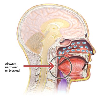Illustration: Obstructive sleep apnea – as described in the article