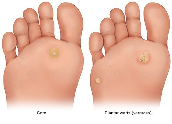 Illustration: It is easy to tell the difference between a corn and a plantar wart (verruca)