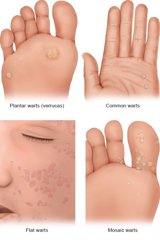Illustration: Different types of warts