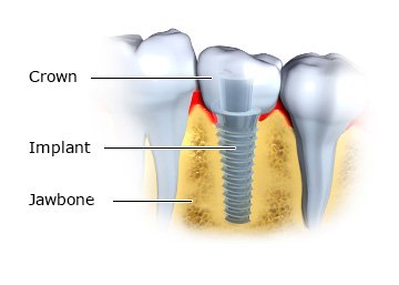 Illustration: Implants with artificial tooth attached at the top - as described in the article