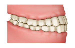 Illustration: In a normal bite, the teeth fit together with a slight overlap
