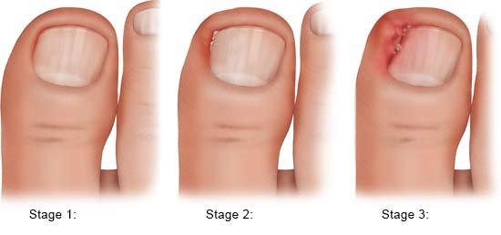 Illustration: Ingrown toenails of various degrees of severity – as described in the article