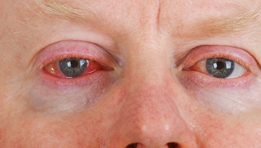 Photo of a man with very red eyes