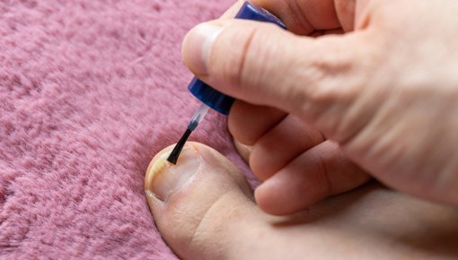 Photo of nail fungus on a big toe being treated with medicated nail polish