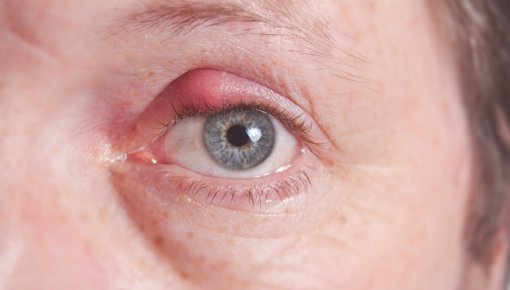 Photo of man with stye on upper eyelid