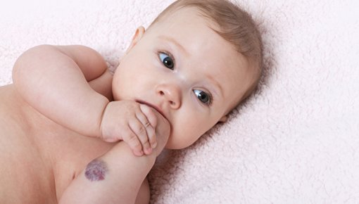 Photo of a baby with a hemangioma on their forearm