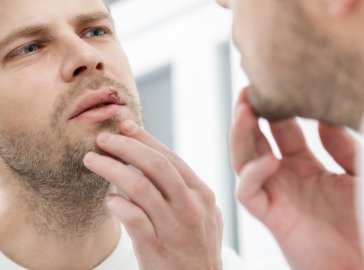 Photo of a man looking at his cold sore in the mirror