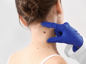 Photo of a larger mole on the neck
