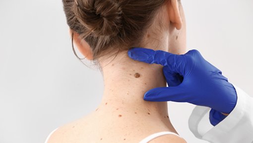 Photo of a larger mole on the neck