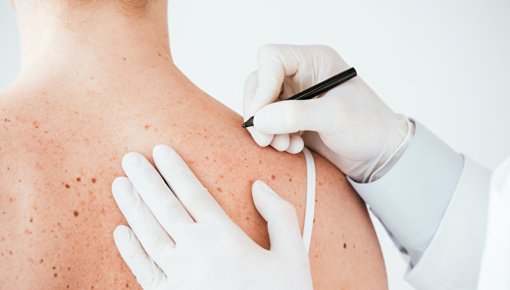Photo of a marking of a skin area on the shoulder blade