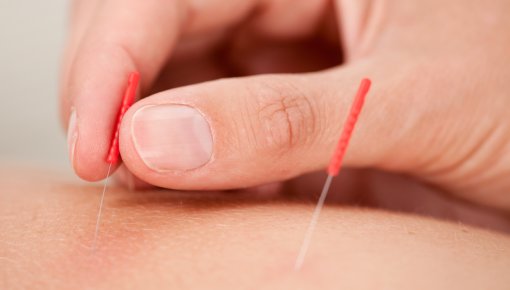 Photo of acupuncture needles