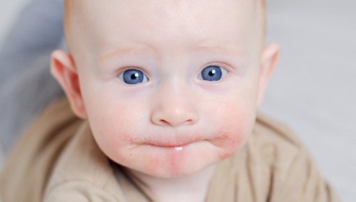 Photo of a baby with facial eczema