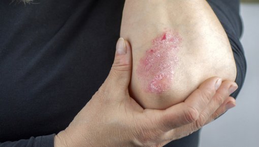 Photo of a woman looking at psoriasis on her elbow