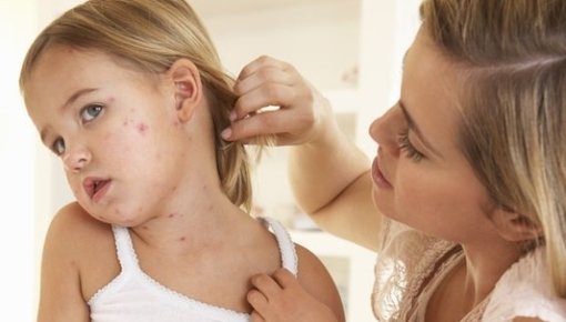 Photo of a mother with her daughter who has chickenpox