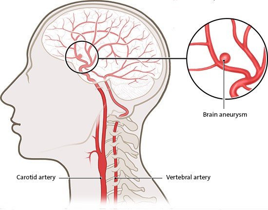 The illustration shows the location of a brain aneurysm in the middle of the brain. There is also an enlarged image of this berry-shaped bulge.