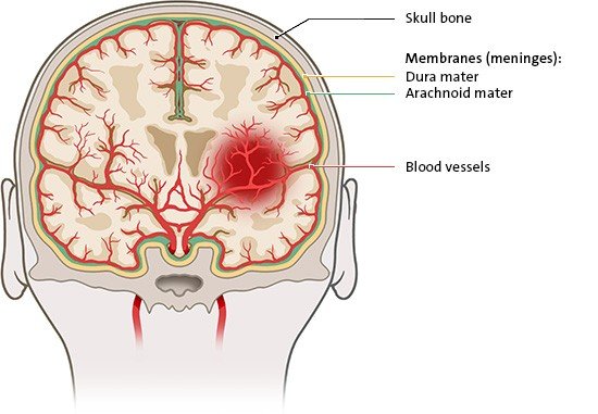 The illustration shows an intracerebral hemorrhage in the middle of the brain, where blood from a cerebral artery leaks into the brain tissue.