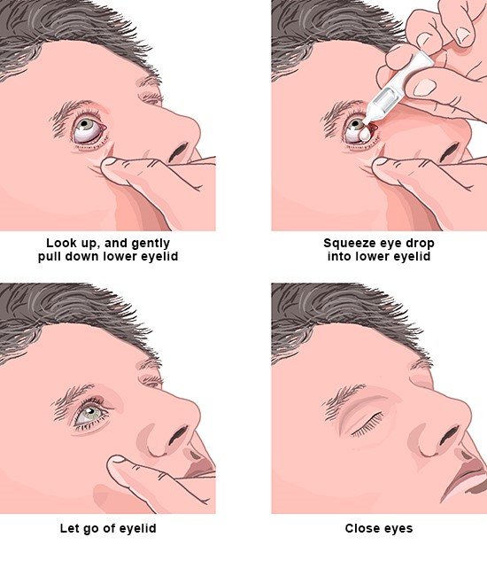 Tips for applying eye drops