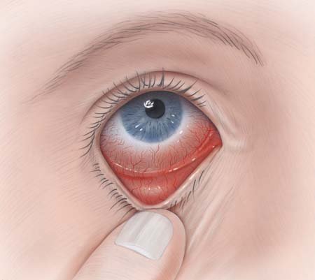 This illustration shows a red eye with inflamed conjunctiva