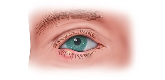 The photo-realistic illustration shows a sty on the lower eyelid.