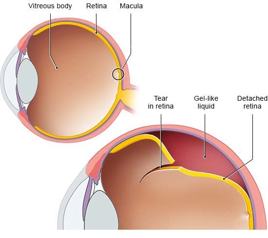 Image: Left: healthy eye, right: eye with retinal detachment caused by a tear