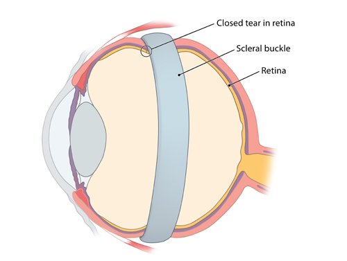 Illustration: Scleral buckling procedures: Scleral buckle