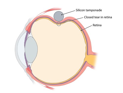 Illustration: Scleral buckling procedures: Silicone tamponade