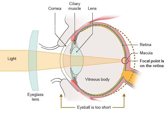 Illustration: Anatomical diagram of an eye plus glasses lens in side view. The beams of light converge to meet at the retina.