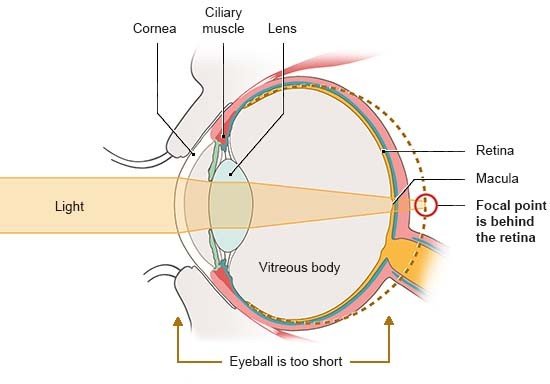 Illustration: Anatomical diagram of the eye in side view. The light rays don’t converge on the retina.