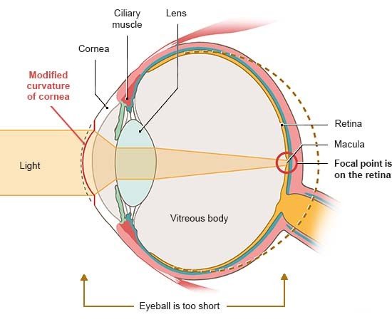 Illustration: Anatomical diagram of an eye in side view. The cornea is more curved, the light beams converge on the retina.
