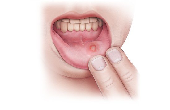This illustration shows a canker sore on the inside of the lip – a whitish-reddish, inflamed area.