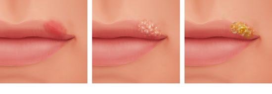 This illustration shows the various ways that cold sores might appear. From left to right: reddening, blisters, crusting.