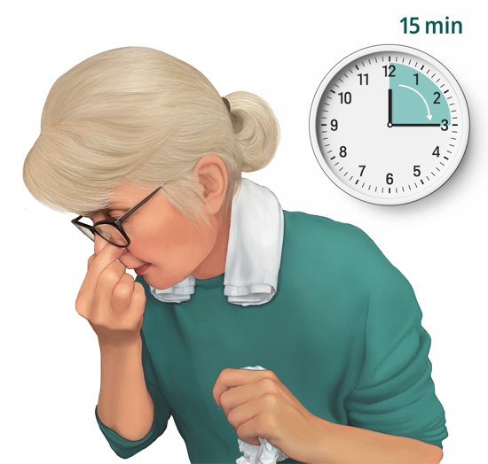 Illustration: Stopping nosebleeds in adults