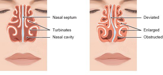 The illustration on the left shows a straight nasal septum. The illustration on the right shows an S-shaped nasal septum