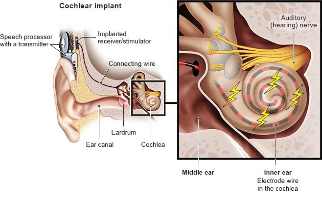 The simplified anatomical diagram shows a cochlear implant in situ. On the right is a detailed view of the electrode cable in the cochlea.