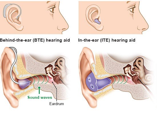This illustration shows examples of behind-the-ear hearing aids (left) and in-the-ear hearing aids (right) as well as their anatomical position and function.