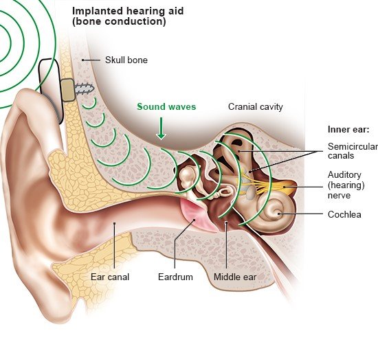 This simplified anatomical illustration shows a bone-anchored hearing aid with implanted screw.