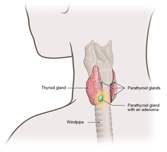The illustration shows a thyroid gland with the four parathyroid glands behind it. One of them contains a single adenoma.